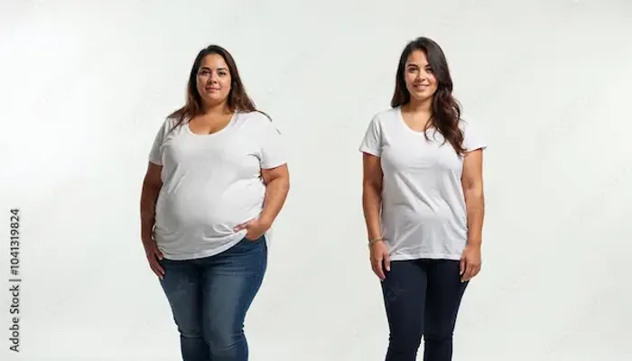 Gastric Bypass Surgery Obesity
